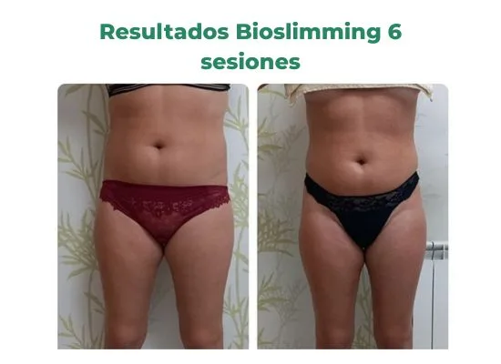 Tratamiento reducción celulitis bioslimming
